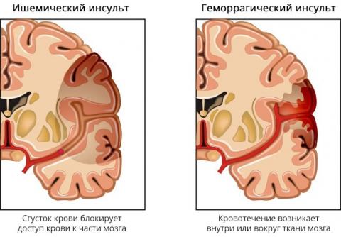 инсульты виды.jpg